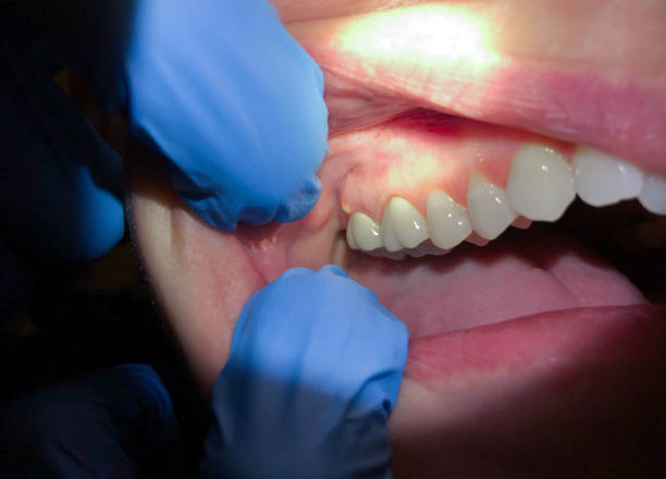 Best Emergency Treatment for Oral Infections in Brookhaven, WV